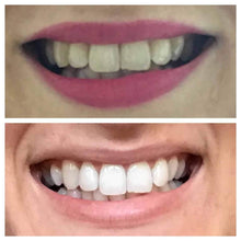 Load image into Gallery viewer, Snow® At-Home Teeth Whitening (ALL-IN-ONE KIT)